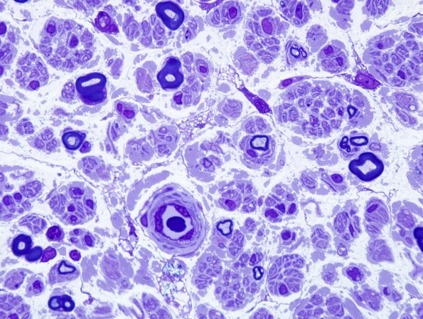 1A2 Vitamin E Def (Case 1) Plastic 100X 4.jpg