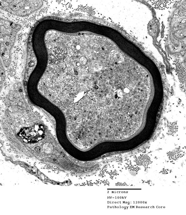 1B10 Vitamin E Deficiency (Case 1) EM 001 - Copy