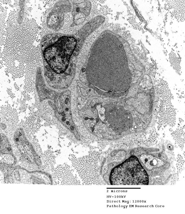 1B1A Vitamin E Deficiency (Case 1) EM 040 - Copy