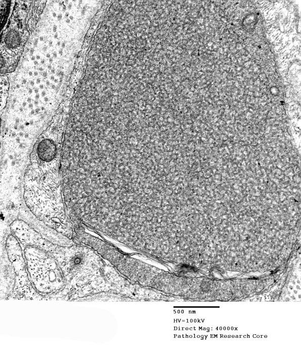 1B1B Vitamin E Deficiency (Case 1) EM 041 - Copy