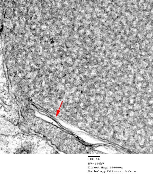 1B1C Vitamin E Deficiency (Case 1) EM 043 - Copy copy