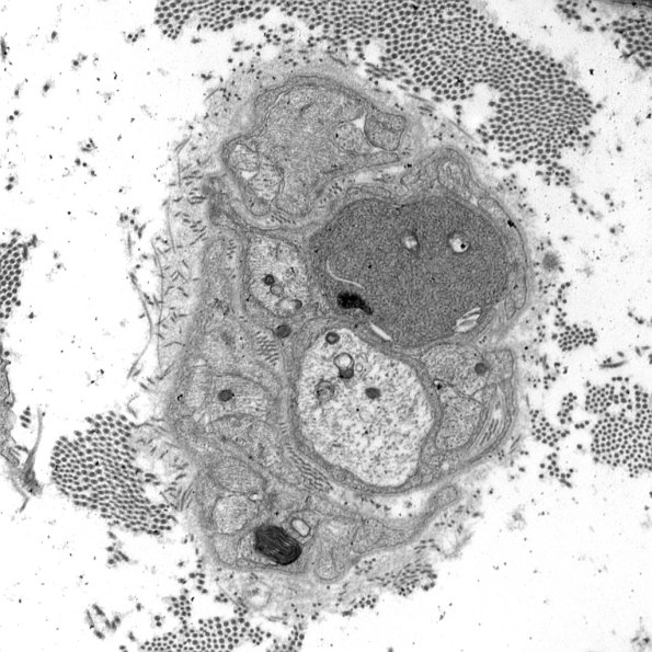 1B2A VitE Def (Case 1)_001 - Copy