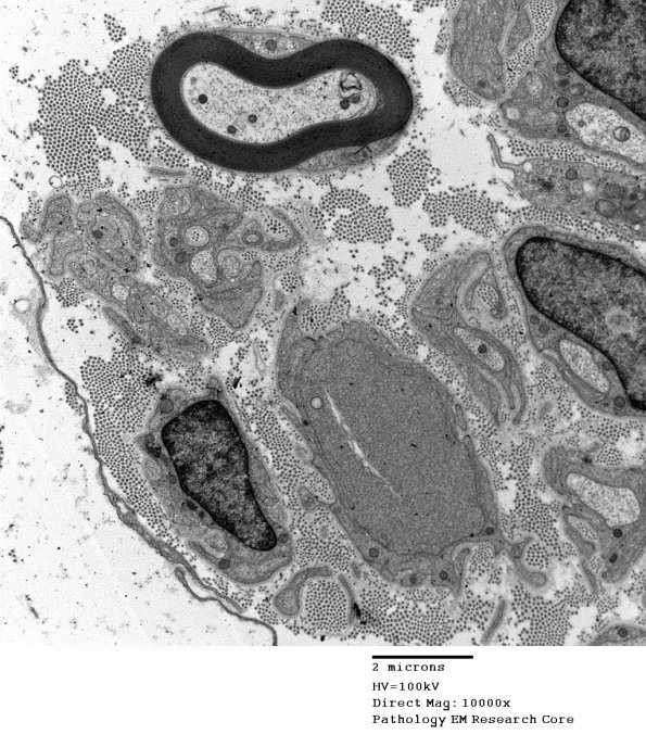 1B5A Fig 17-10 VitE Def (Case 1)_009 - Copy