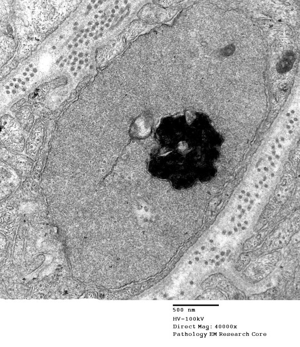 1B8B Vitamin E Deficiency (Case 1) EM 011 - Copy