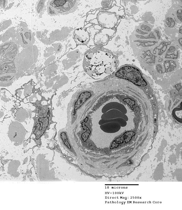1C1 Vit E Deficiency (Case 1)_005 - Copy.jpg