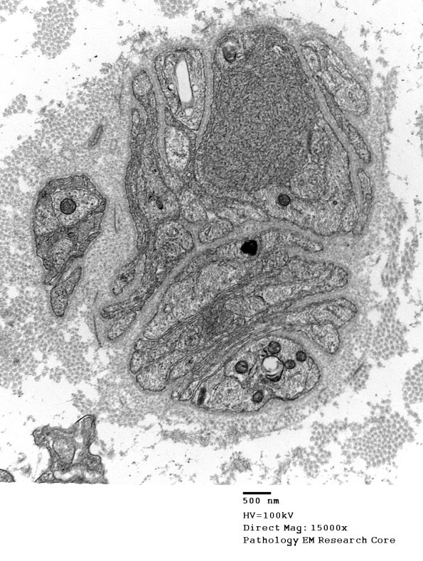 2A1 Vit E Deficiency (Case 2) - Copy