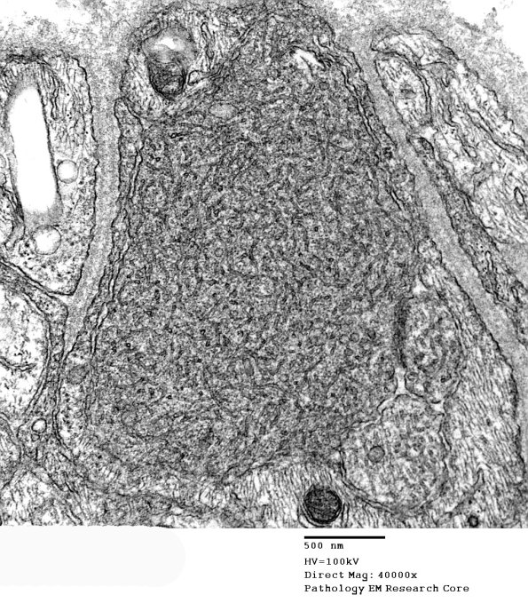 2A2 Vit E Deficiency (Case 2) - Copy