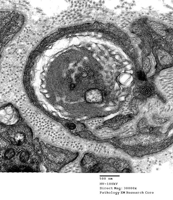 2A3 Vit E Deficiency (Case 2) - Copy