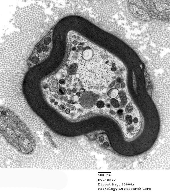 2A4 Vit E Deficiency (Case 2) - Copy