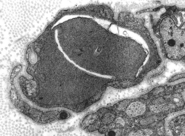 4A Vitamin E deficiency (Case 4) - Copy