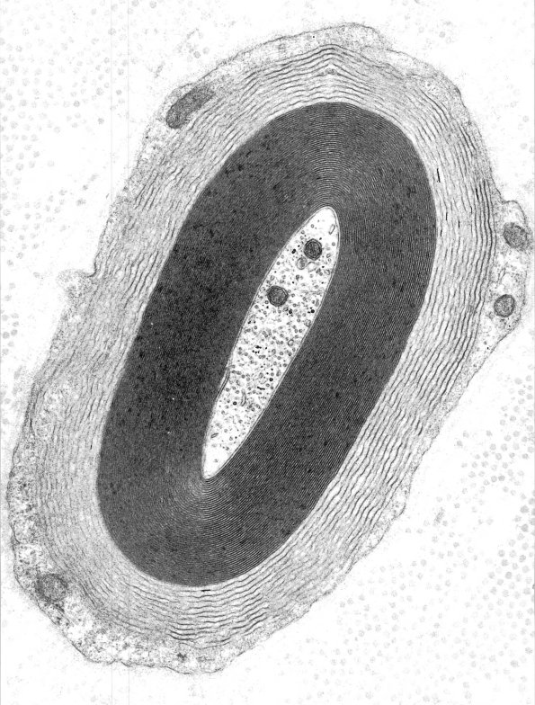 3A1 Anti-MAG EM 21 (Case 3) Copy