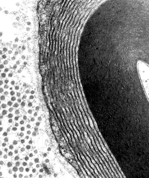 3A2 Anti-MAG EM 22 - (Case 3) Copy