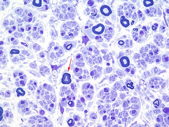 5A Two tone Myelin (Case 5) Plastic 1 1 (2) copy.jpg