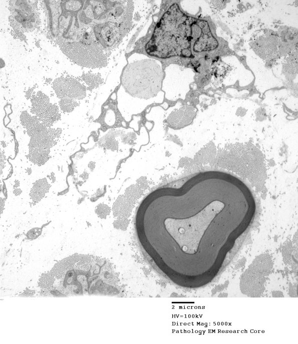 5B1 Two Tone Myelin (Case 5)_006 (2) - Copy