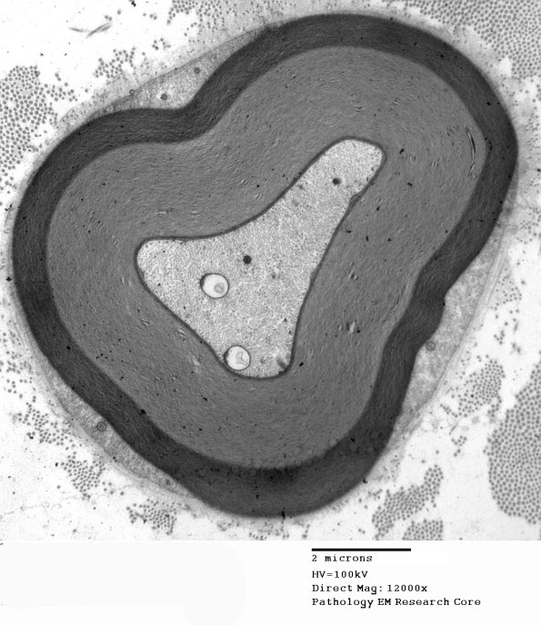 5B2 Two Tone Myelin (Case 5)_004 - Copy