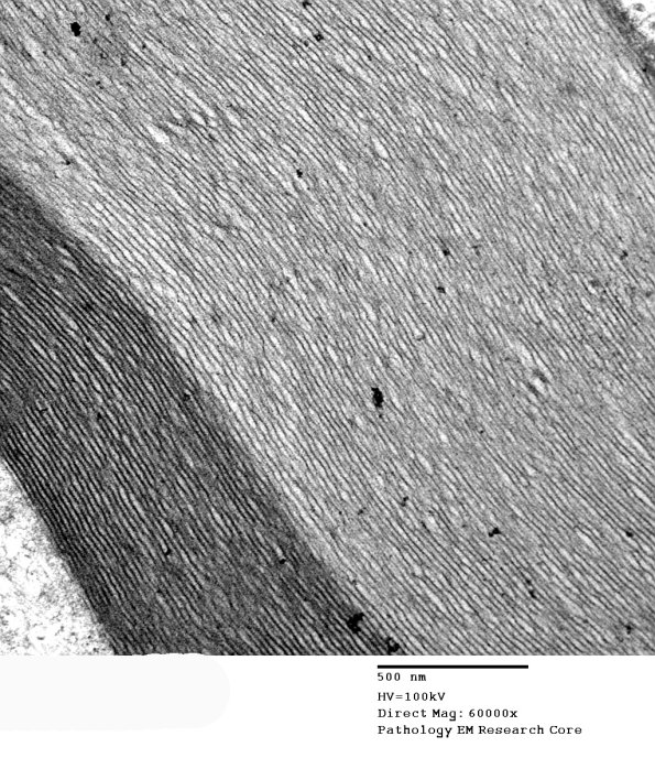 5B3 Two tone Myelin in VitE Def (Case 5)_045 - Copy