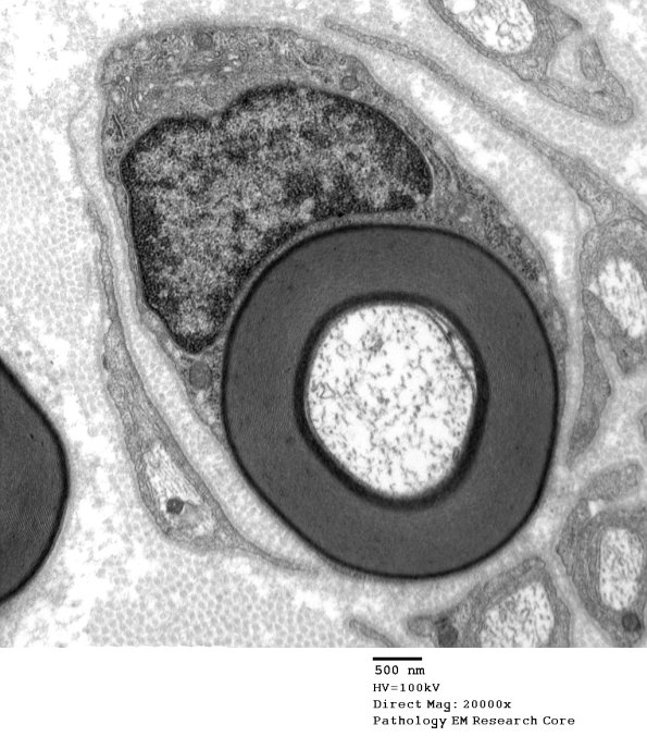 6A1 Two-tone myelin, Paraprotein NP (Case 6) EM 046 - Copy