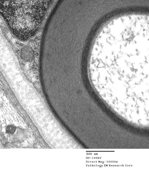 6A2 Two-tone myelin, Paraprotein NP (Case 6) EM 047 - Copy