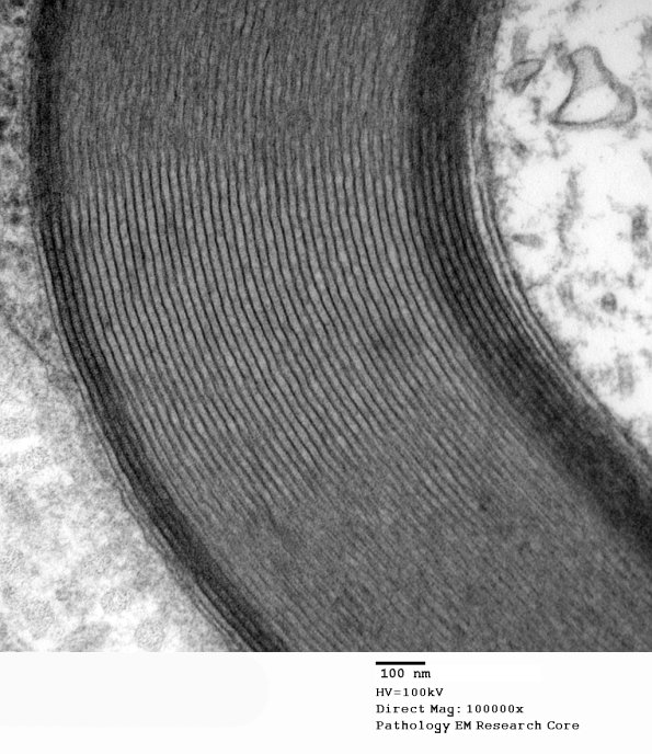 6A3 Two-tone myelin Paraprotein NP (Case 6)_048 - Copy