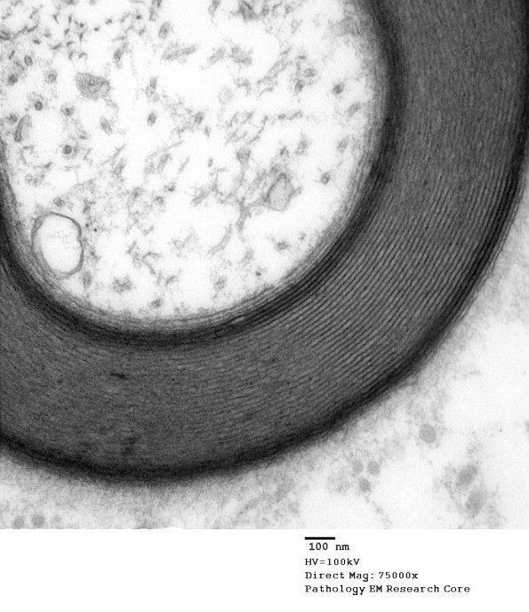 6A4 Two-toned myelin (Case 6) EM 006 - Copy