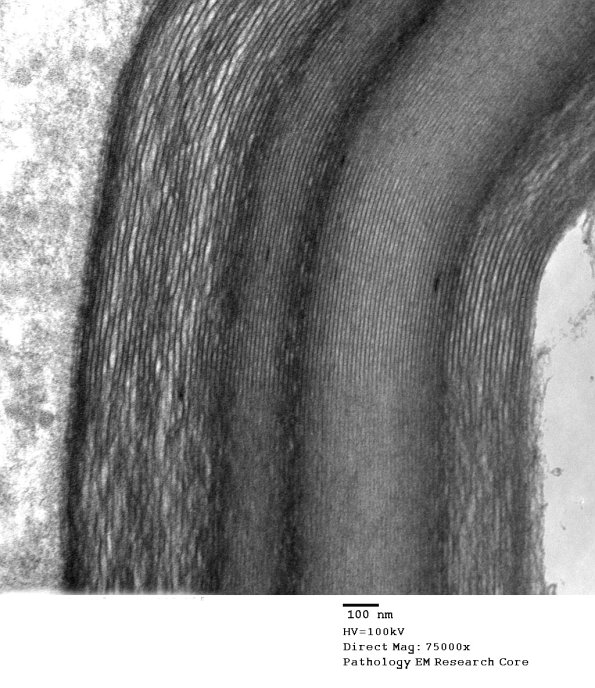 7A2 (Case 7) Unusual myelin EM 005 - Copy