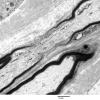 10A1 Node of Ranvier, Diabetic NP (Case 2) EM 074 - Copy