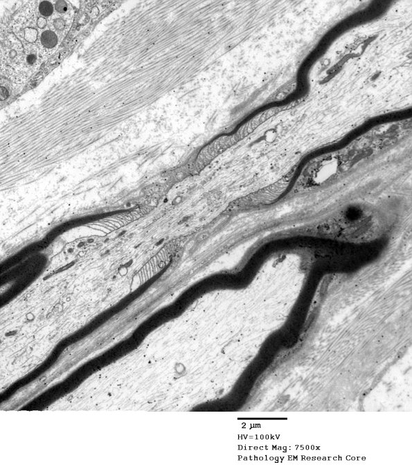 10A1 Node of Ranvier, Diabetic NP (Case 2) EM 074 - Copy