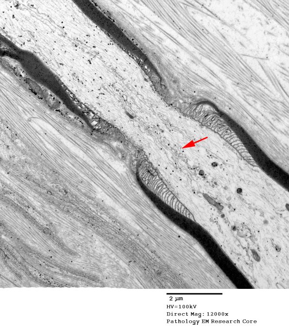 10A2 Node of Ranvier, Diabetic NP (Case 2) EM012 copy - Copy