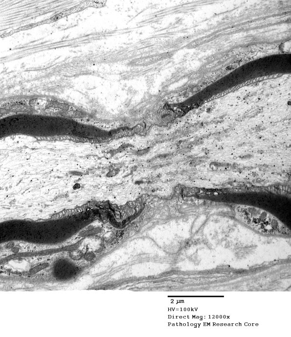 10A3 Node of Ranvier, Diabetic NP (Case 2) EM 049 - Copy