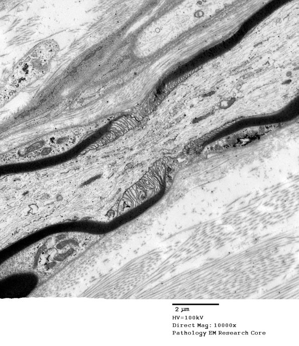 10A4 Node of Ranvier, Diabetic NP (Case 2) EM 054 - Copy