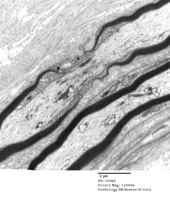 10A5 Node of Ranvier, Diabetic NP (Case 2) EM 063 - Copy
