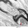 12A1 Node of Ranvier, Diabetic NP (Case 2) EM021 copy - Copy