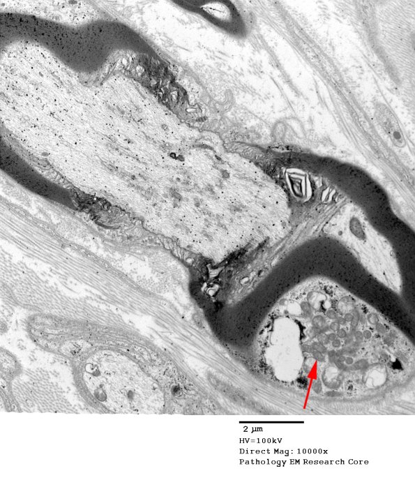 12A1 Node of Ranvier, Diabetic NP (Case 2) EM021 copy - Copy