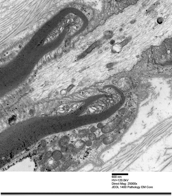 12A2 Node Ranvier (Case 2 longitudinal  012 - Copy