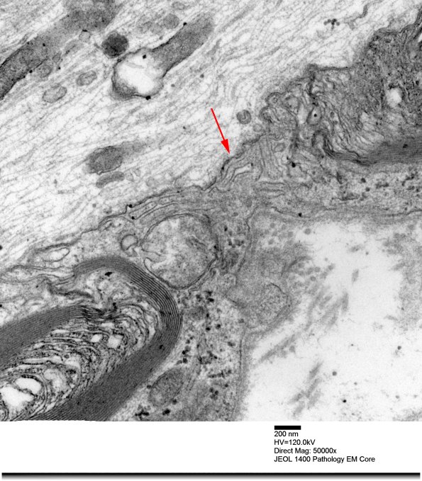 12A3 Node Ranvier (Case 2 longitudinal  013 copy - Copy