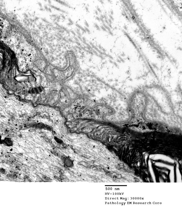 12A4 Node of Ranvier, Diabetic NP (Case 2) EM022 - Copy
