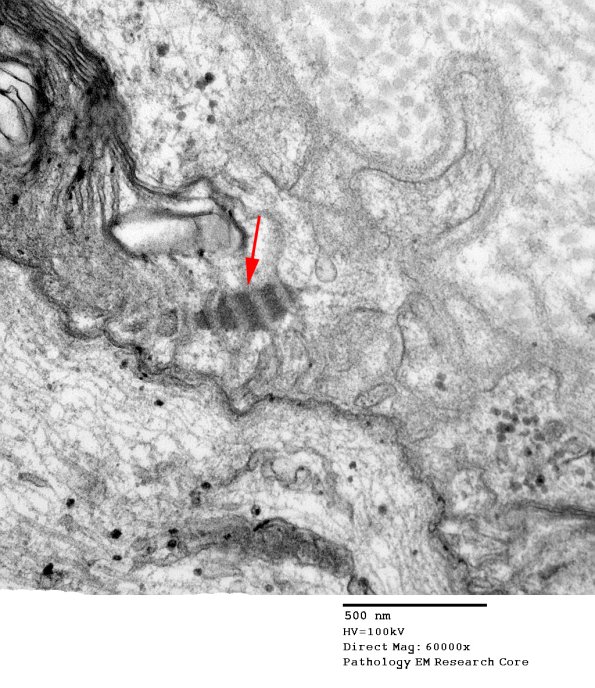 12A5 Node of Ranvier, Diabetic NP (Case 2) EM023 copy - Copy