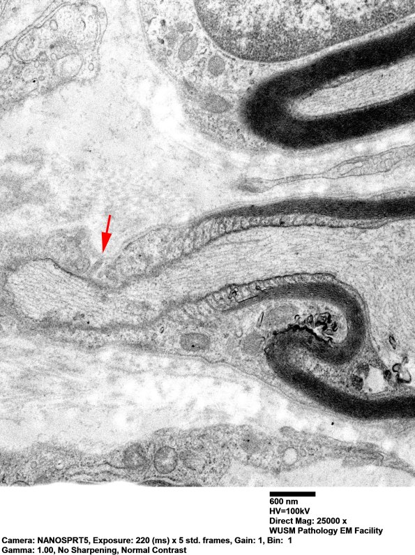 13A1 Node of Ranvier (Case 10) EM 018 copy - Copy