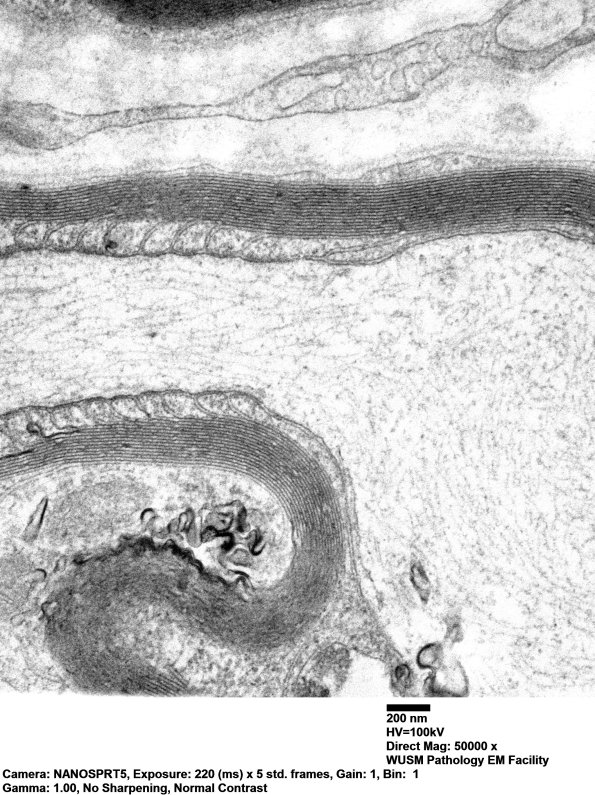 13A2 Node of Ranvier (Case 10) EM 019 - Copy