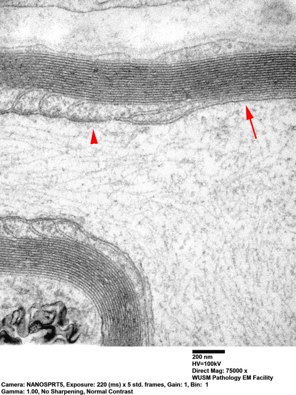 13A3 Node of Ranvier (Case 10) EM 022 copy - Copy
