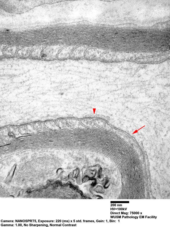13A4 Node of Ranvier (Case 10) EM 023 copy - Copy