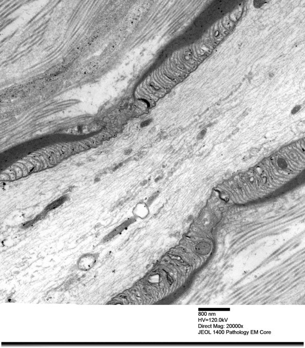 14A1 Node Ranvier (Case 2 longitudinal  002 - Copy