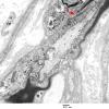 15A1 Node of Ranvier, Diabetic NP (Case 2) EM 034 copy - Copy