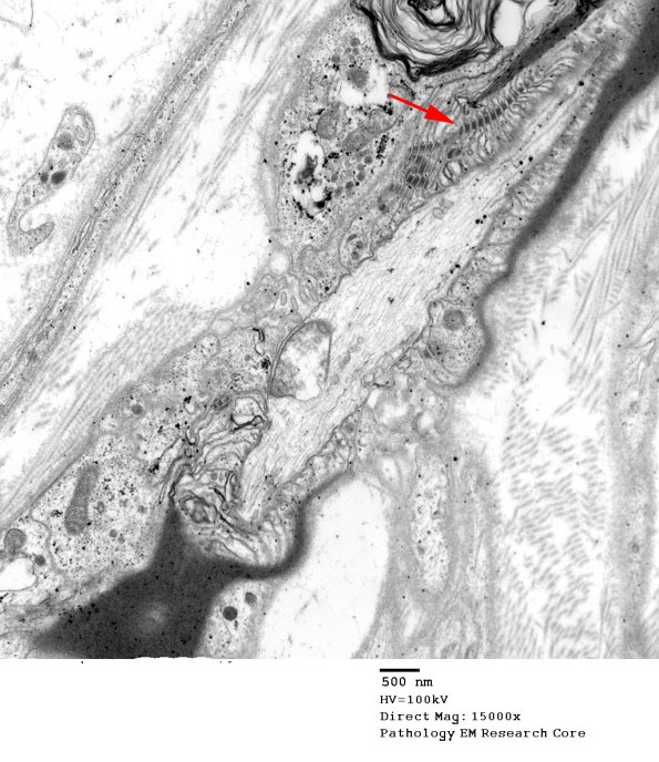 15A1 Node of Ranvier, Diabetic NP (Case 2) EM 034 copy - Copy
