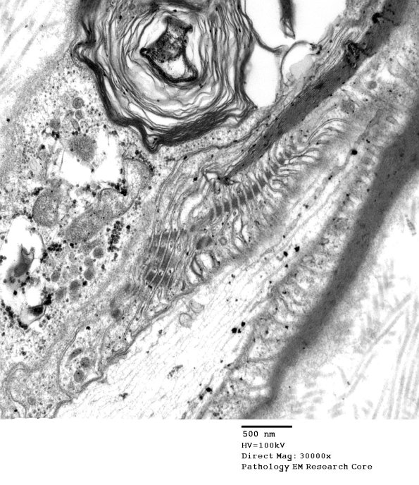 15A2 Node of Ranvier, Diabetic NP (Case 2) EM 036 - Copy