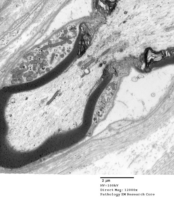 2A Paranodal apparatus, Diabetic NP (Case 2) EM 084 - Copy