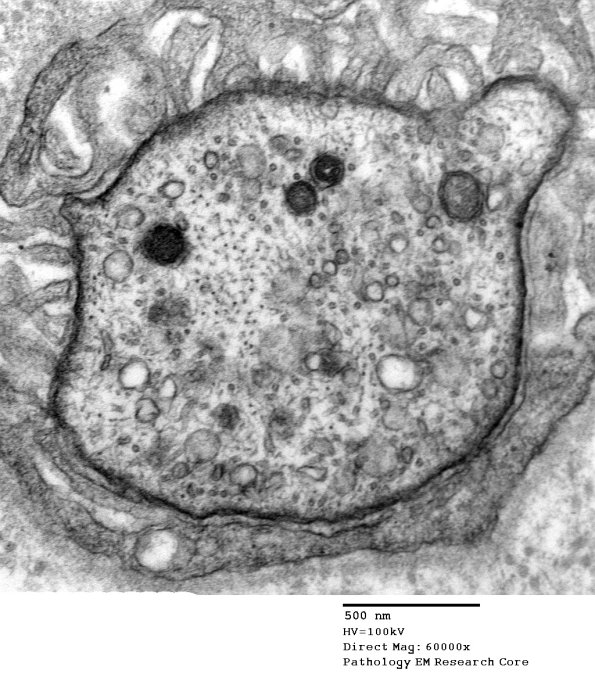 5A2 Node of Ranvier (Case 4, GBS) EM 021 - Copy