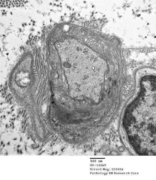8A1 Axonal Degeneration Case 7 EM 060 - Copy (2)
