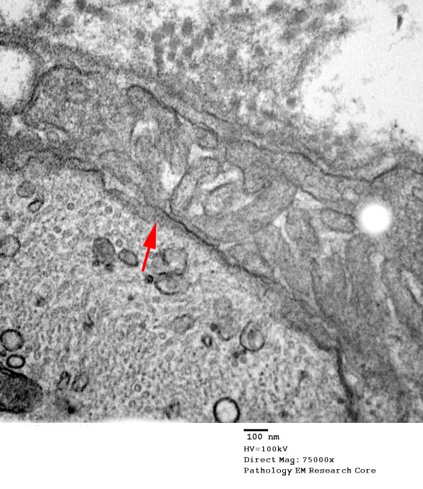 8A3 Axonal Degeneration Case 7 EM 063 copy.jpg