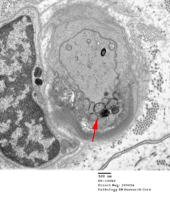 8A4 Axonal Degeneration Case 7 EM copy.jpg